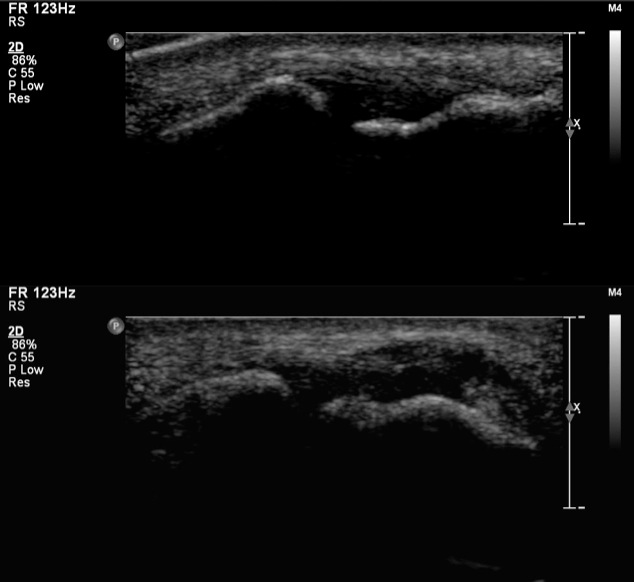 Figure 2 for case Radial collateral ligament ( RID2416 ) tear